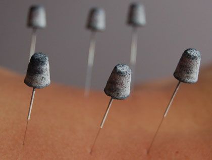 2 forms of Moxibustion - Direct & Indirect