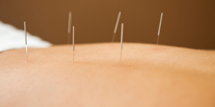 Acupuncture