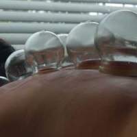 Cupping produces a strong suction on the skin