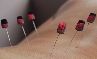 A parallel therapy to acupuncture