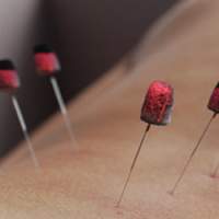 A parallel therapy to acupuncture